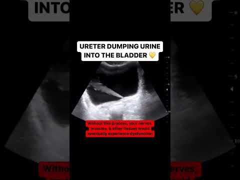 Ureter jetting urine into the bladder